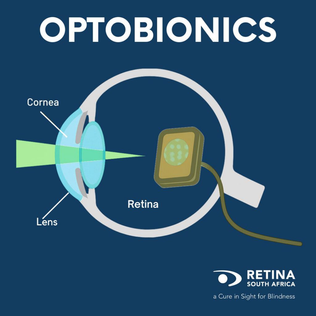 Medical illustration titled “OPTOBIONICS” showing a cross-sectional view of a human eye with labeled parts including cornea, lens, and retina. A device is shown interfacing with the retina, connected by a wire, suggesting a technological treatment for vision restoration. Includes Retina South Africa logo and tagline “a Cure in Sight for Blindness.”